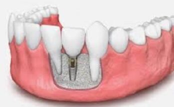 Dental Implants in Islam: Are They Permissible?