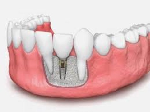 Dental Implants in Islam: Are They Permissible?
